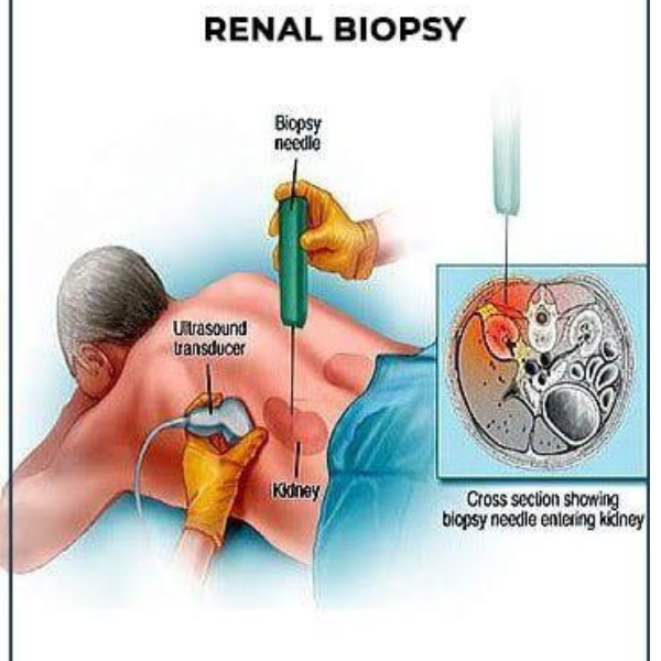 Kidney Biopsy