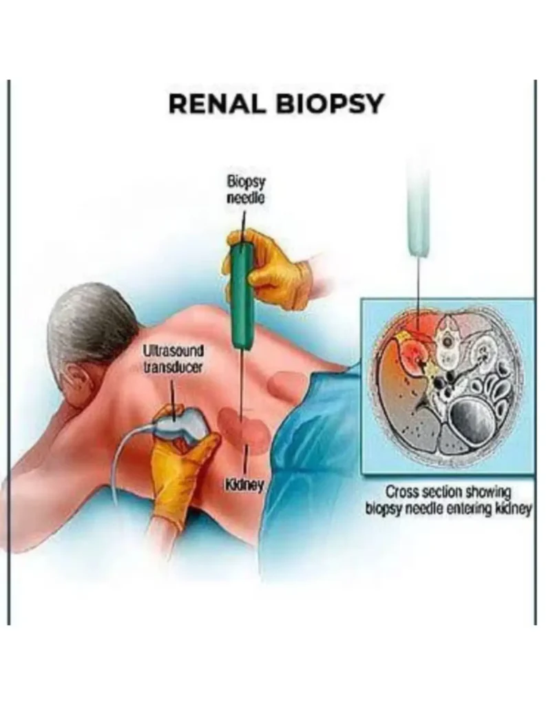KIDNEY BIOPSY